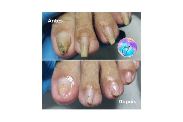Foto de antes e depois do tratamento 7